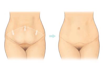 Abdominoplasty-A5 Abdominoplasty-A5