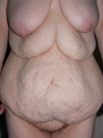 Body Contouring 1  Body Contouring 1