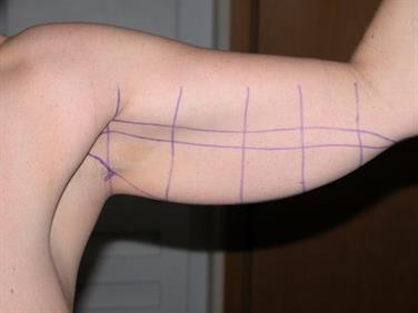 Body contouring arm 1