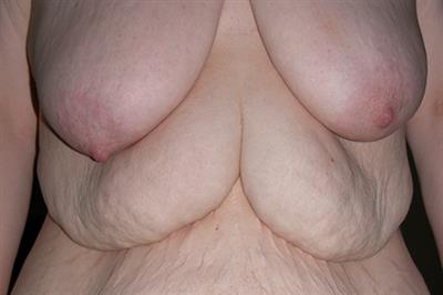 Body contouring image - 5 Body contouring image - 5