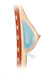 BREAST~3 BREAST~3
