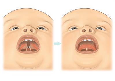 Cleft palate-A5 Cleft palate-A5