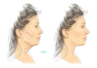 Face lift-A5 Face lift-A5