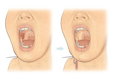 Mouth cancer-A5 Mouth cancer-A5