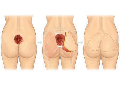 Pressure sore-A5 Pressure sore-A5