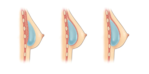 Implant Techniques