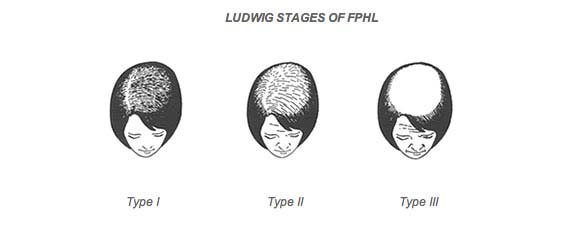 female pattern hair loss