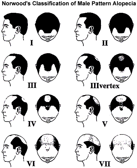 hair transplant infographic hair transplant infographic