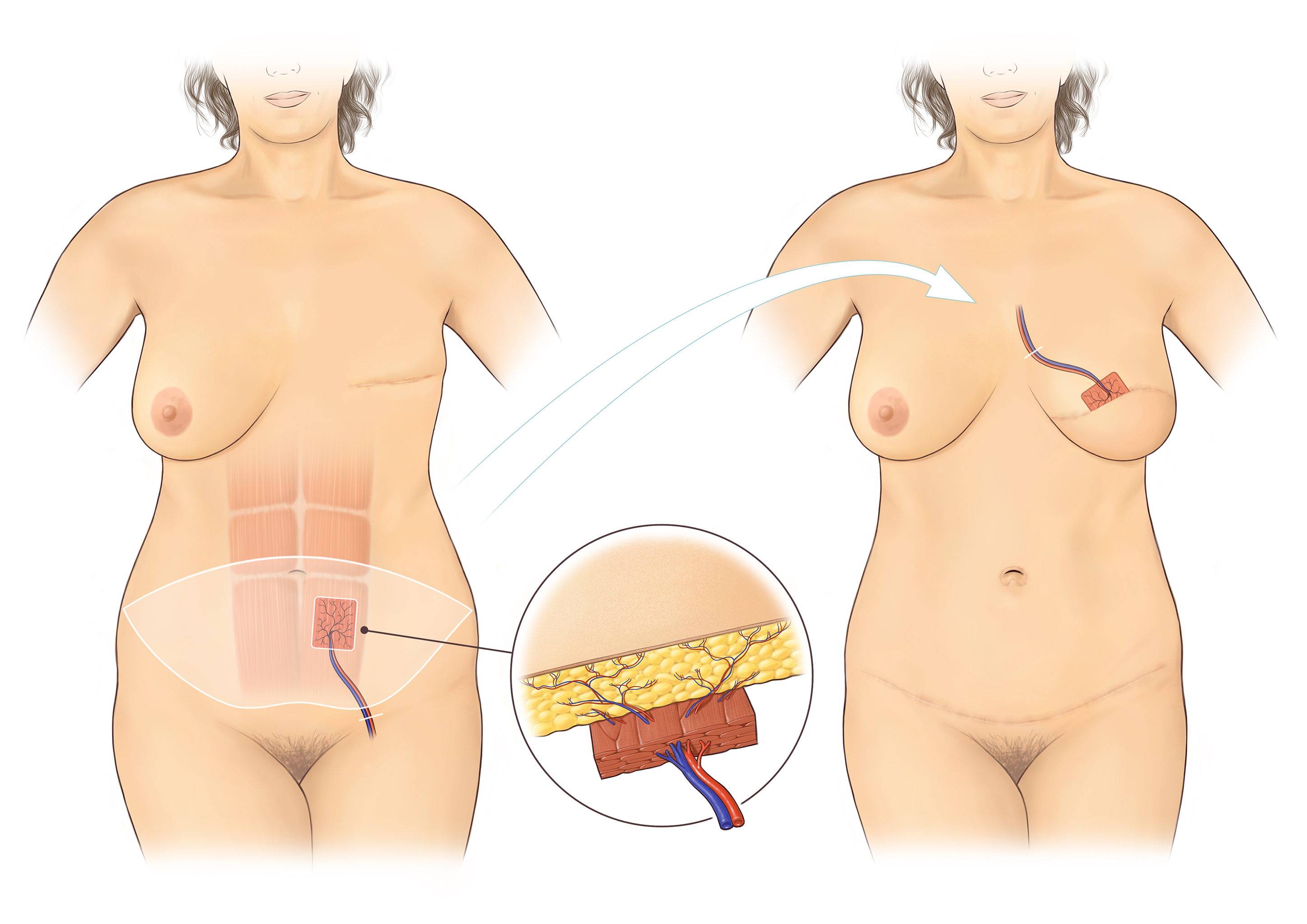 3.Abdominal flap(A5)