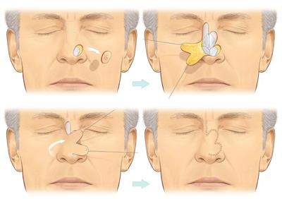 Bilobed flap-A5 Bilobed flap-A5
