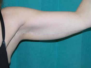 Body Contouring arm 2 