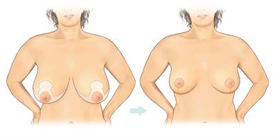 Breast reduction-Anchor_A3 - figure 1