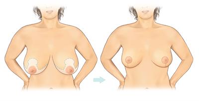 Breast reduction-Anchor_A3 - figure 1 Breast reduction-Anchor_A3 - figure 1