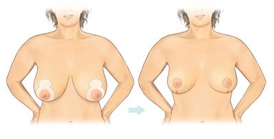 Breast reduction-Vertical_A3