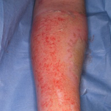 Burn- Deep partial thickness