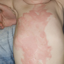 Burn- Erythema