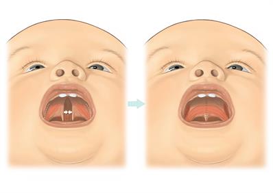 Cleft palate-A5