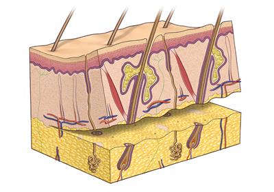 Full skin graft Full skin graft