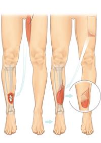 Lower limb flap-A5 Lower limb flap-A5
