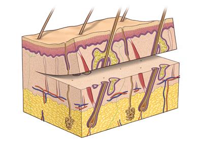 Partial skin graft