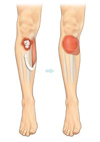 regional muscle flap-A5 regional muscle flap-A5