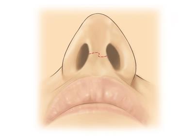 Rhynoplasty-preop nose Rhynoplasty-preop nose