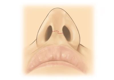 Rhynoplasty-preop nose