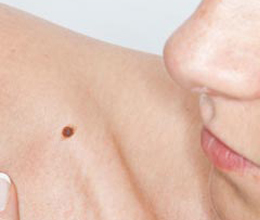 New NICE skin cancer quality standard